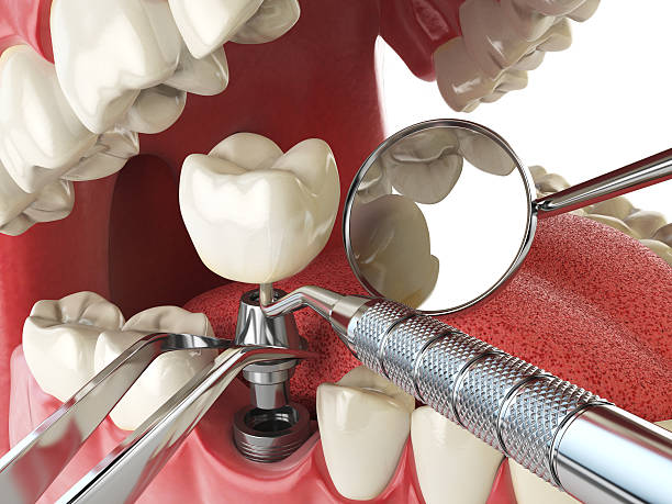 Best Emergency Broken Tooth Repair in Springdale, SC